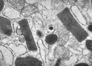 M,59y. | nasopharynx - crystalline inclusions - plasmocytoma M,59y. | nasopharynx - crystalline inclusions - plasmocytoma